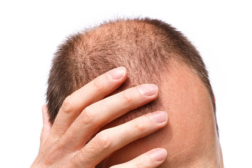 زراعة الشعر في الرياض.. تجربتي الشخصية مع أفضل مركز