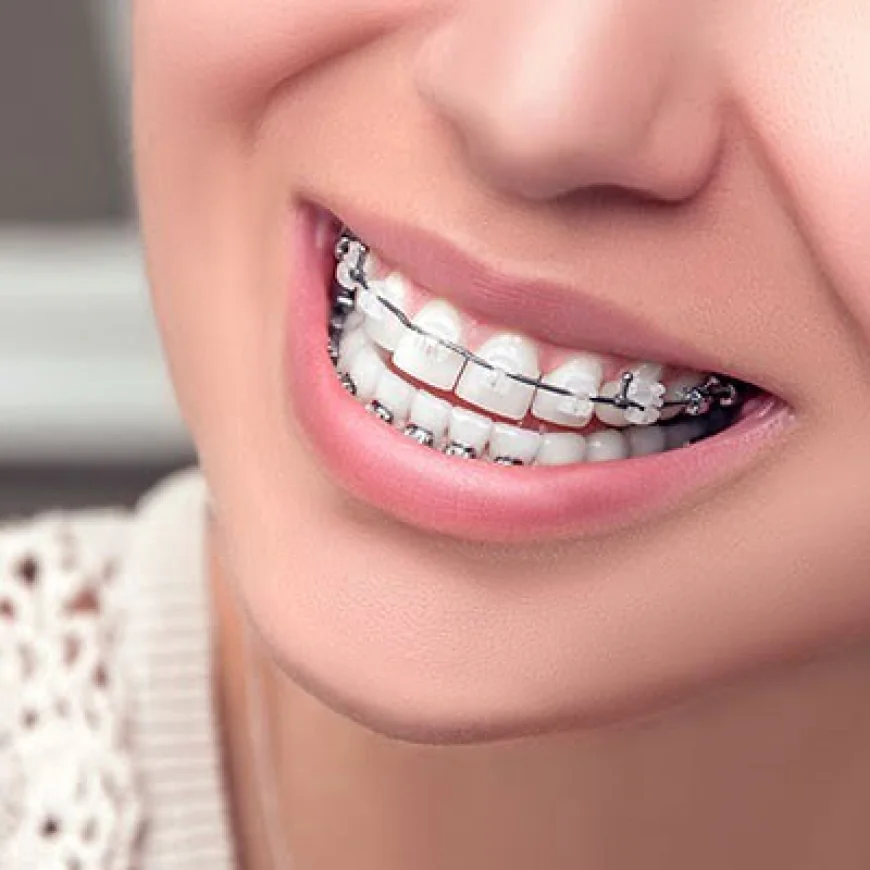 Orthodontists’ Top Tips for Pain-Free Braces