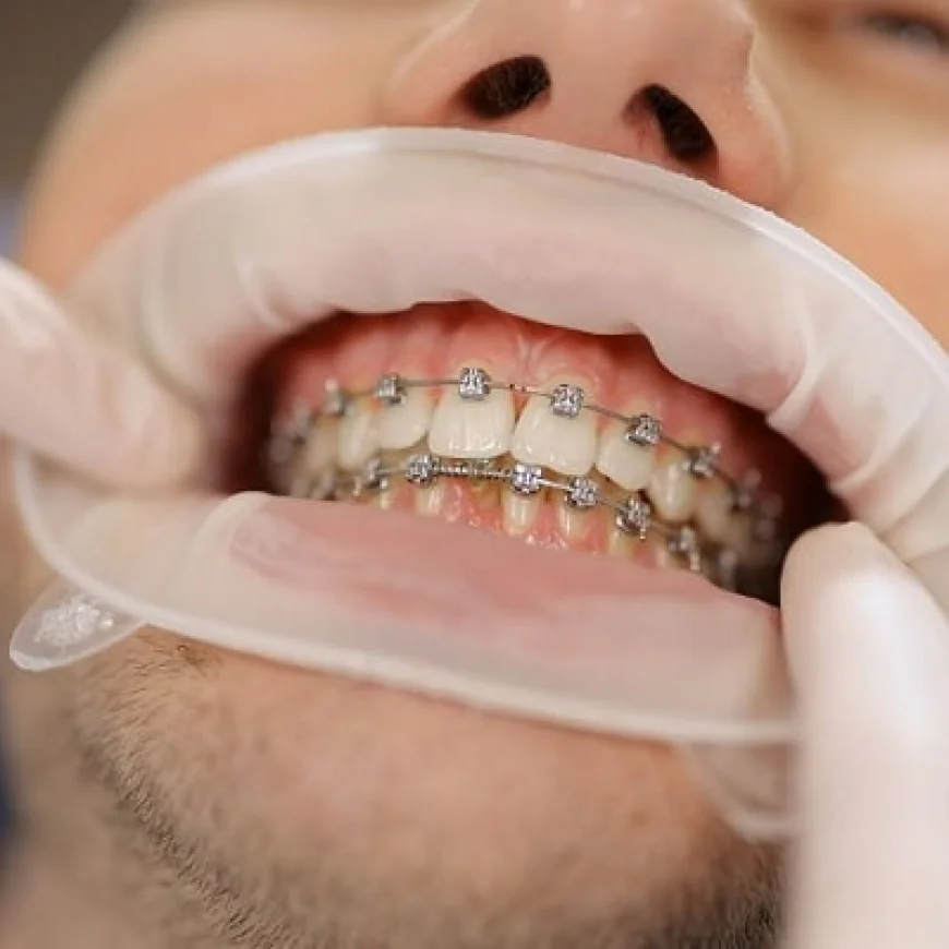 Orthodontists Reveal Secrets to Braces Longevity