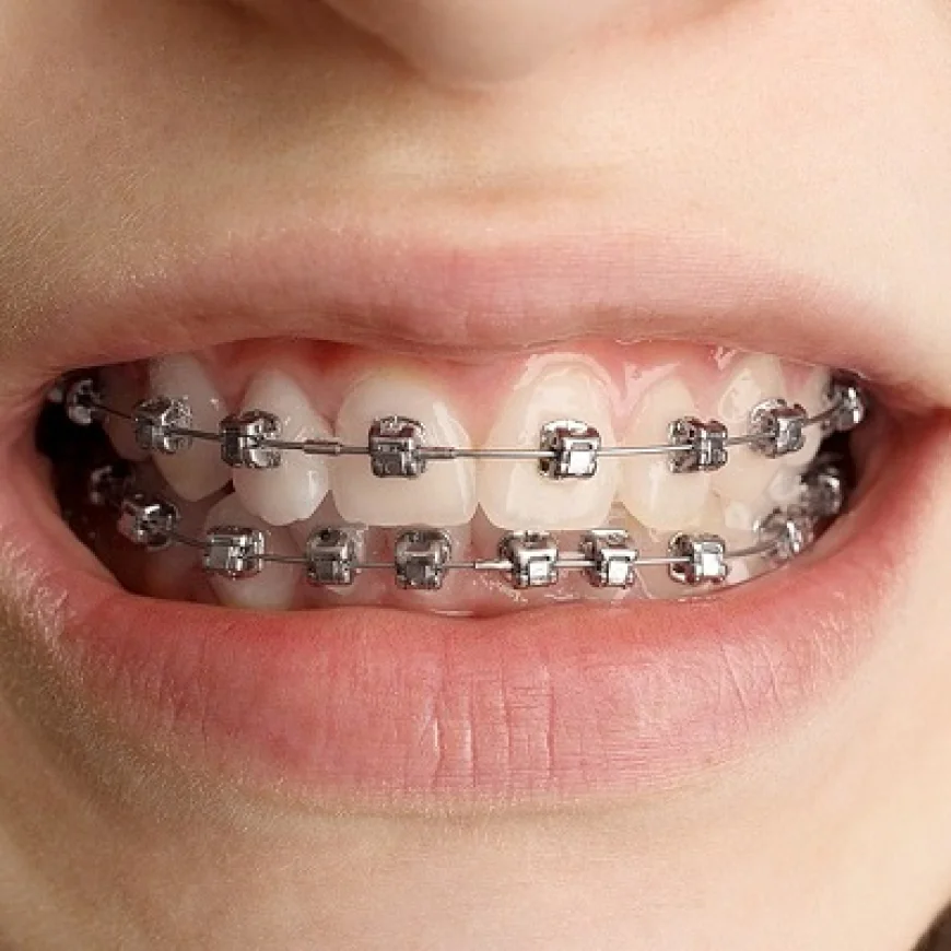 Cleaning Teeth Braces: Step-by-Step Oral Care Guide