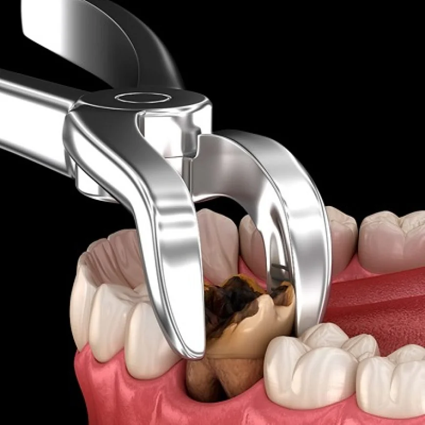 Why Tooth Removal Helps Maintain Healthy Gums
