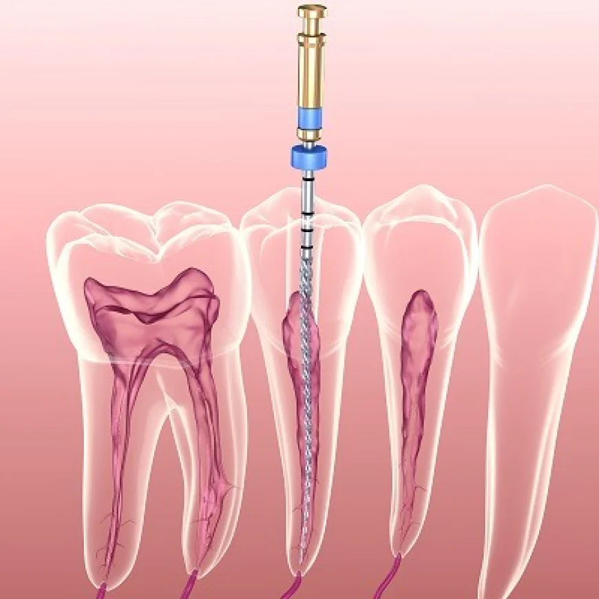 Swollen Gums and Root Canal Treatment Connection