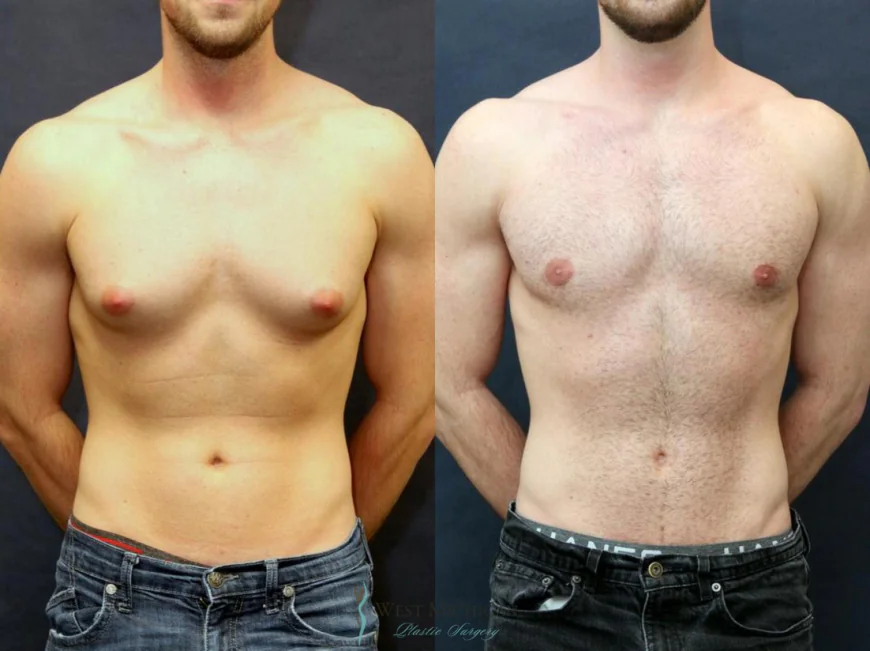 Gynecomastia Treatment in Islamabad – A Complete Overview