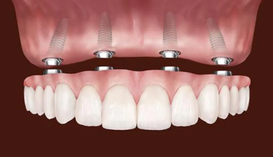 All-on-4 vs. Traditional Implants: Which One Is Right for You