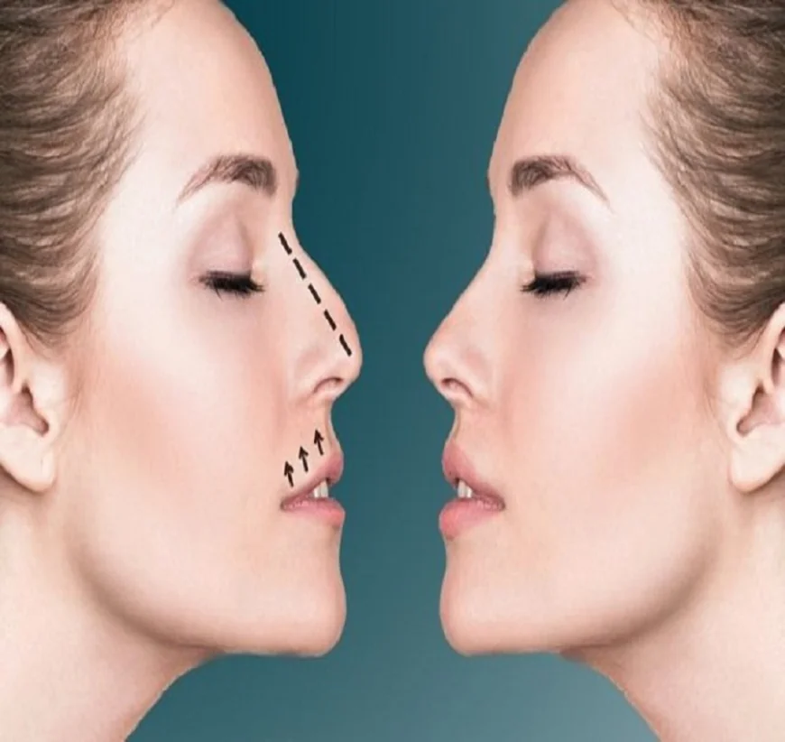تكلفة عملية تجميل الأنف بالرياض: دليل الأسعار الشامل لعام 2025
