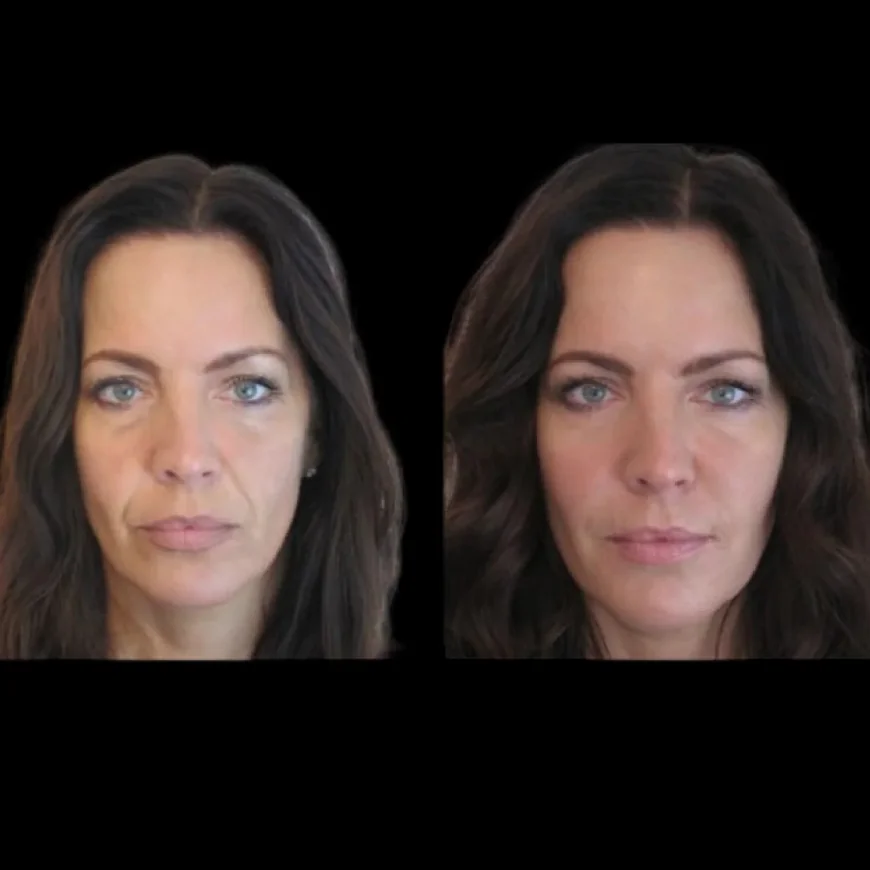 Quick Recovery Tips after Jawline Fillers Treatments in Dubai