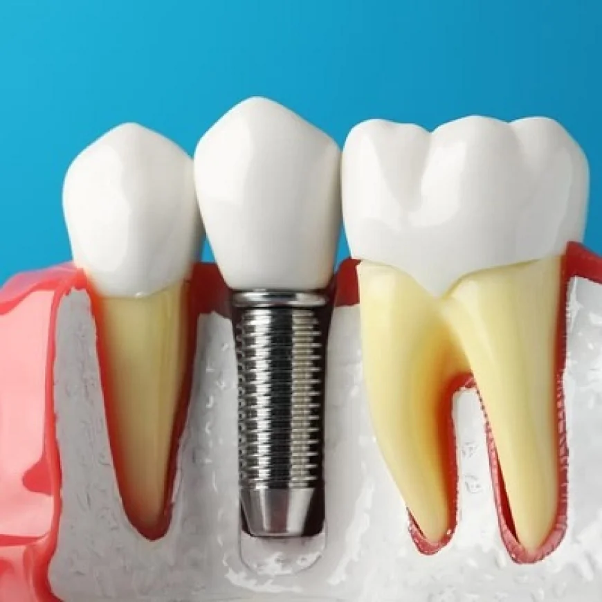 Dental Implants: A Complete Beginner’s Guide