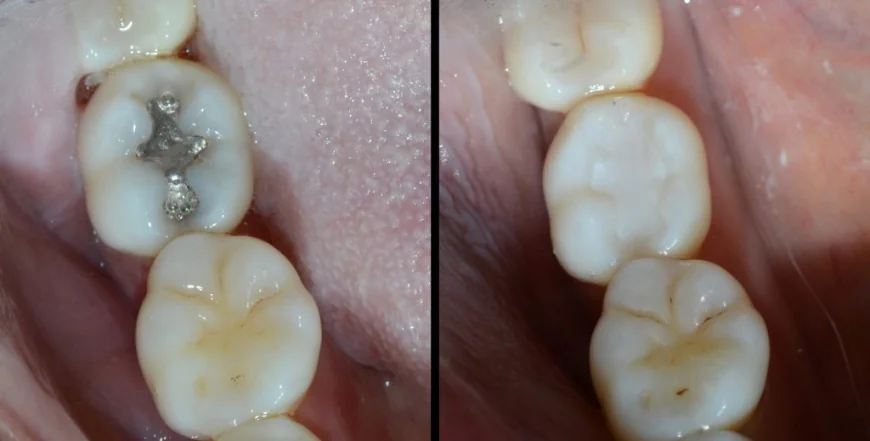 Is Dental Filling in Islamabad the Right Choice to Save Your Tooth and Restore a Healthy Smile?