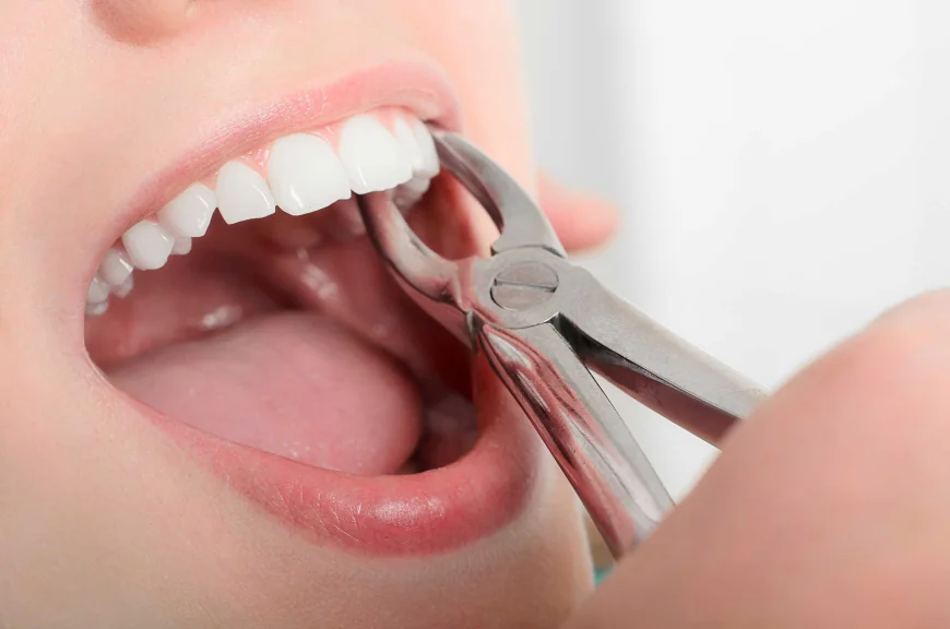 How Much Is Tooth Extraction Cost in Dubai?