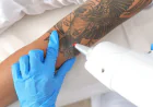 The Complete Guide to Saline Tattoo Removal: A Safer Alternative to Laser Treatments
