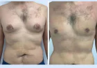 Long-Term Results: How to Maintain Your Chest Contour After Gynecomastia in Dubai