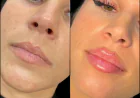 Achieve Timeless Beauty with the Best Doctors in Dubai for Fillers