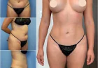 Body Contouring in Dubai: What to Expect from Consultation to Recovery