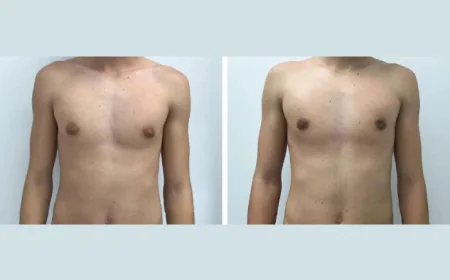 Gynecomastia Surgery in dubai: Transform Your Chest, Transform Your Life