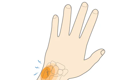 Comprehensive Overview of Ulnar Styloid and Hairline Wrist Fractures