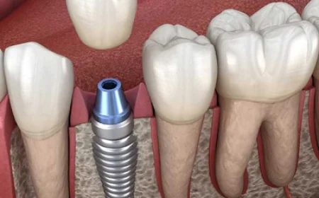 Are Dental Implants Stronger Than Real Teeth?