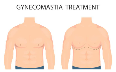 Postoperative care tips for gynecomastia surgery patients