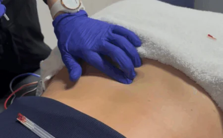 Dry Needling: A Complete Guide to Pain Relief and Recovery at Flexology Studios