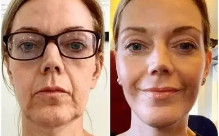 Awaken True Glow with Profhilo Treatment in Dubai