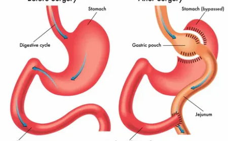 Gastric Bypass vs Mini Bypass: Choosing the Right Weight Loss Surgery in Islamabad