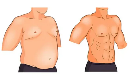Gynecomastia in Islamabad – A Modern Solution for Male Breast Reduction