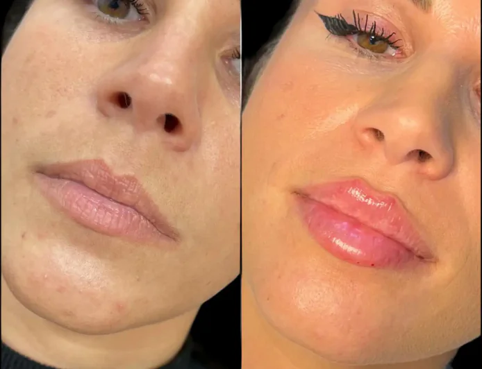 Achieve Timeless Beauty at the Best Aesthetic Clinic in Dubai for Fillers