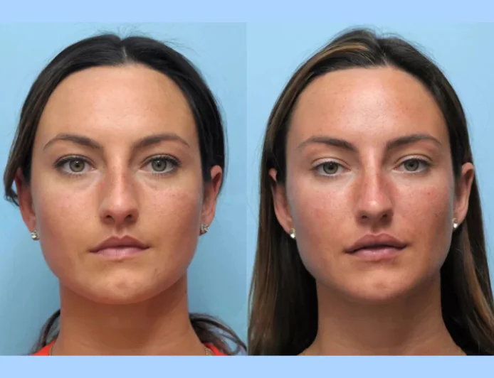 Best Plastic Surgeon in dubai for thread lift Using Premium Medical Threads