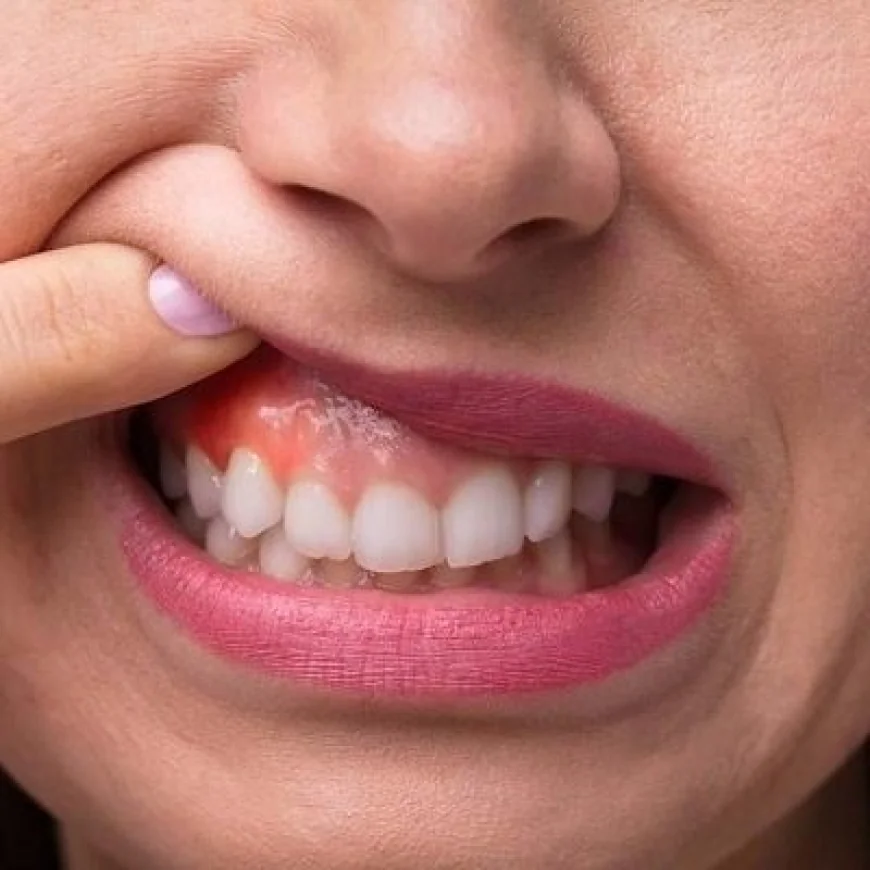 Can Gum Depigmentation Help with Self-Esteem?