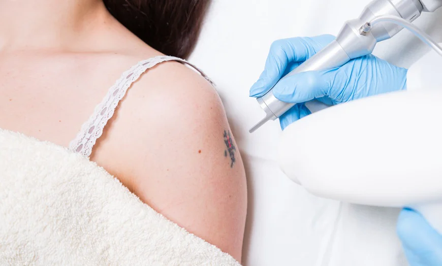 Laser Tattoo Removal Treatment in Islamabad – A Safe Way to Clear Unwanted Ink