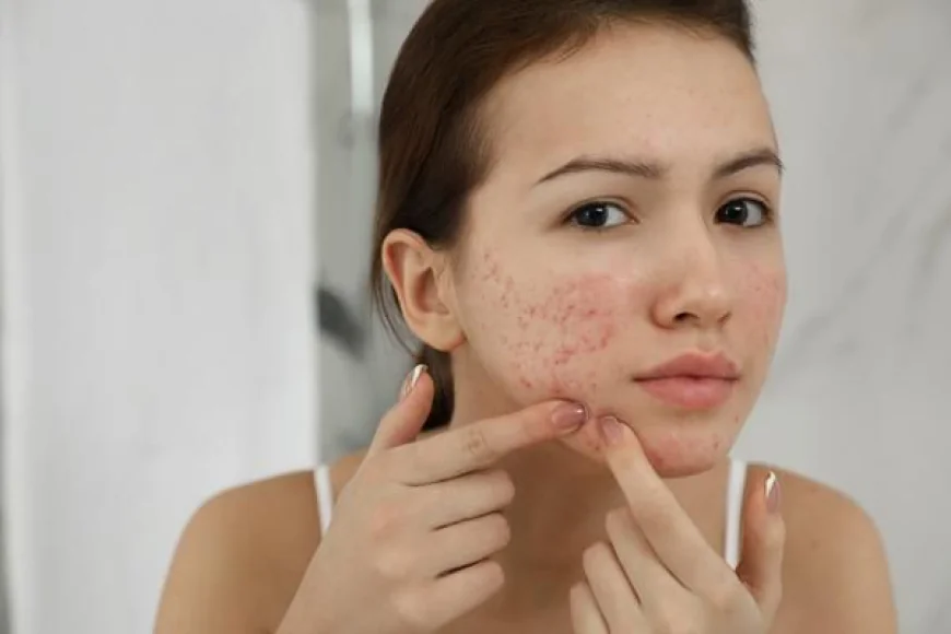 Top-Rated Acne Treatment Clinics in Riyadh