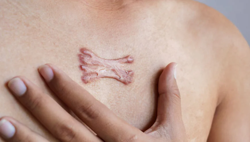 Navigating Keloid Treatment During the Summer in Islamabad