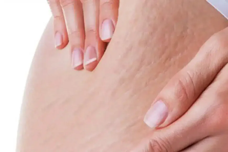 Do teens need laser stretch marks treatment Dubai?