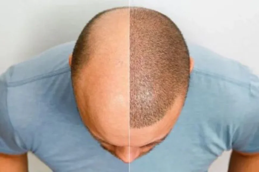 Hair Transplant Cost in Islamabad: The Complete 2025 Guide
