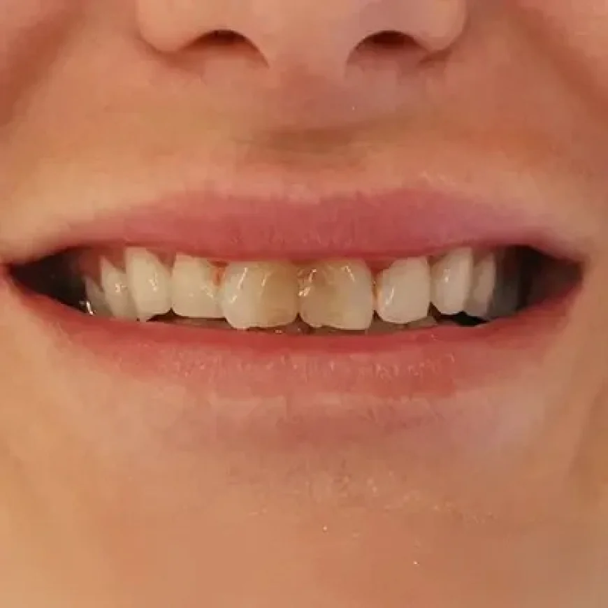 Emax Veneers Recovery Time: Quick or Lengthy?