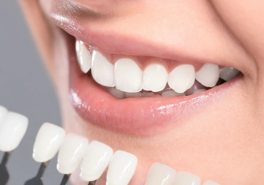 The Process of Getting Dental Veneers in Islamabad Explained