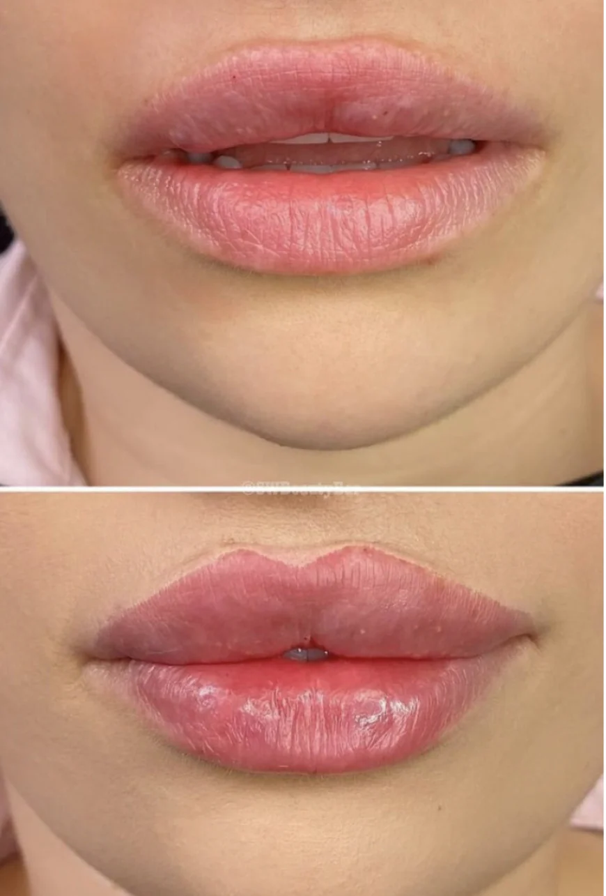 Lippenaufspritzen, aber bitte natürlich – Die wissenschaftlichen Aspekte hinter ästhetisch perfekter Lippenmodellierung