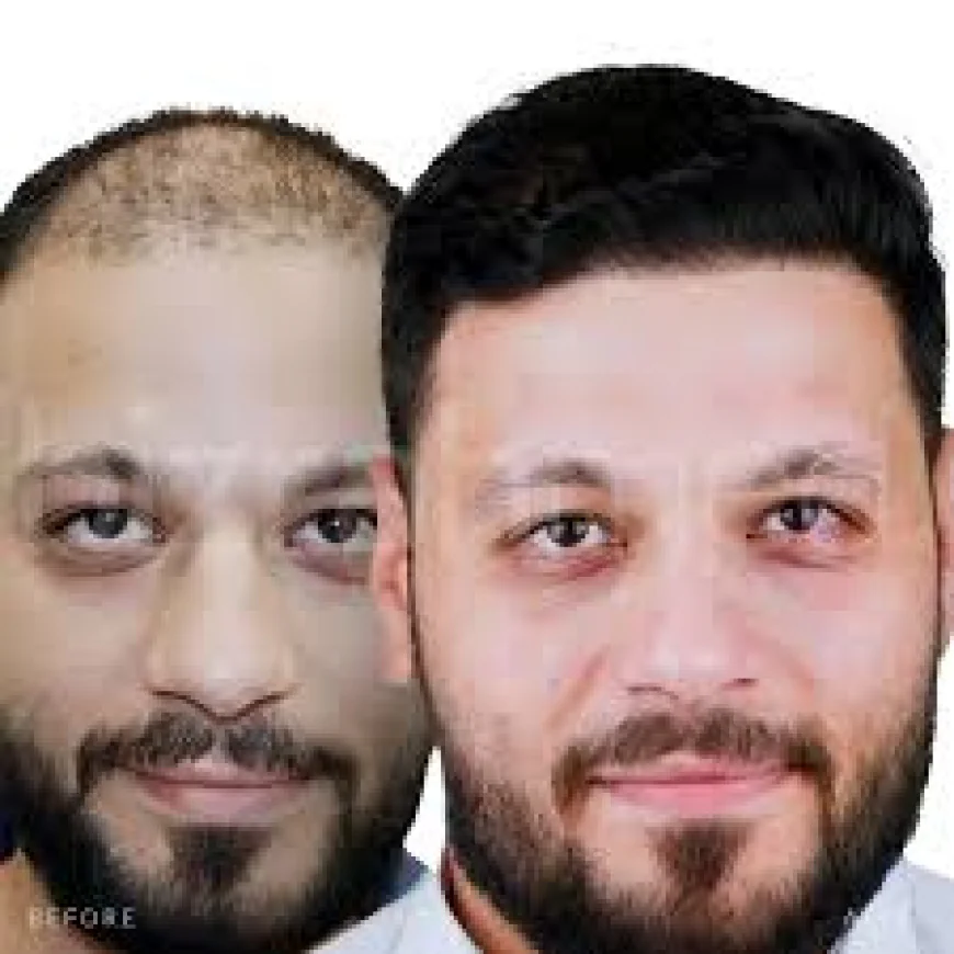 Achieve Natural Results with Hair Transplants in Riyadh
