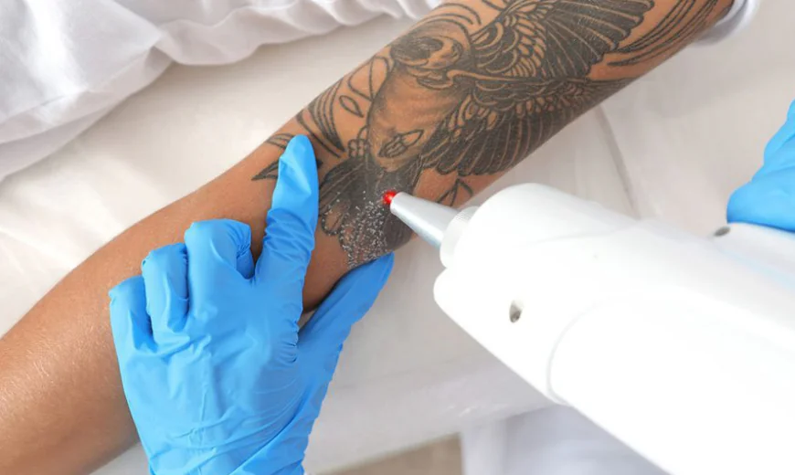 The Complete Guide to Saline Tattoo Removal: A Safer Alternative to Laser Treatments