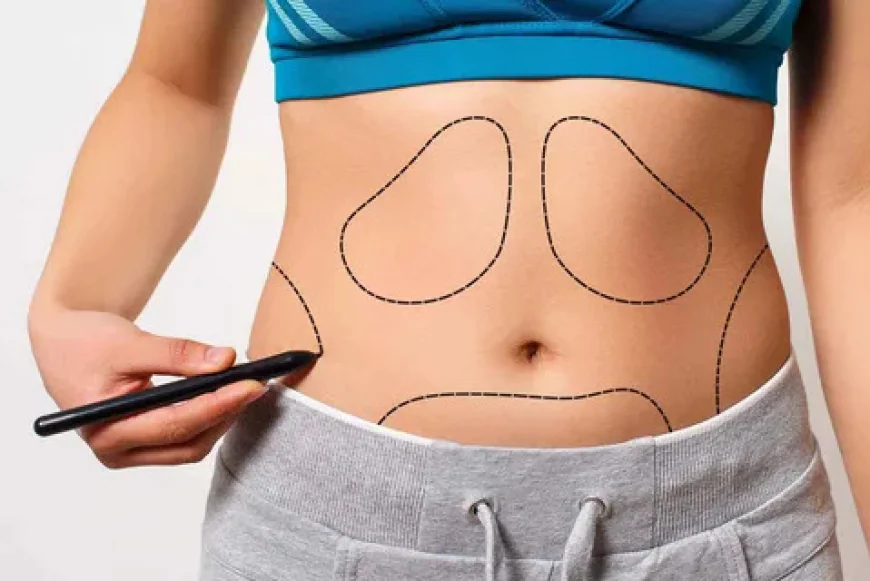 How Expensive is Liposuction in Islamabad?