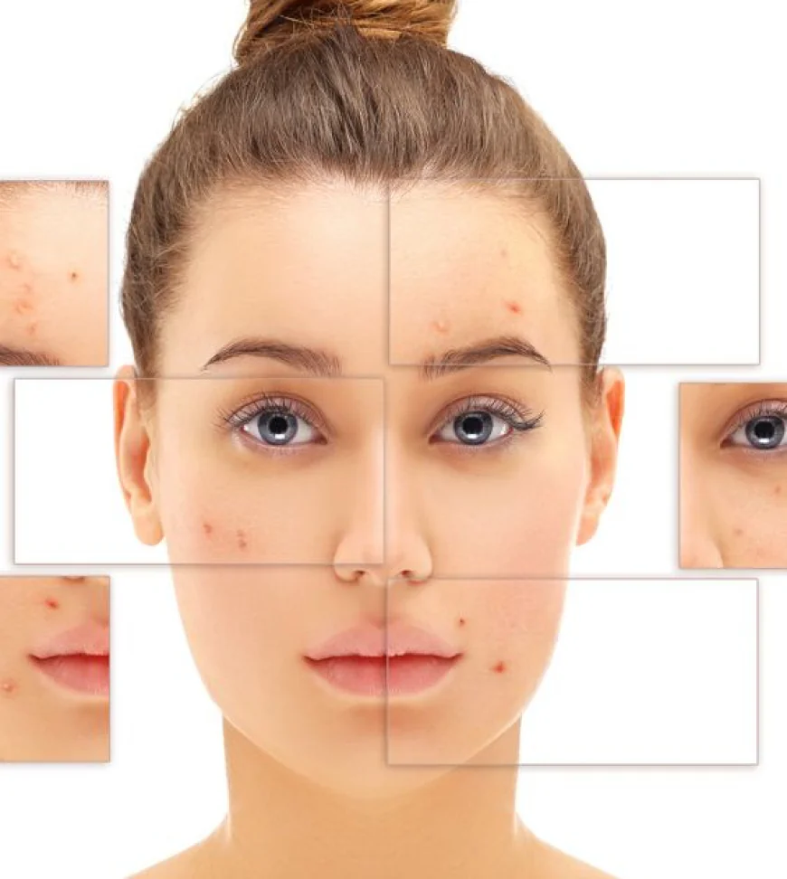 How Laser Helps with Both Active Acne and Scars