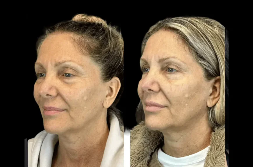 Why the Best Plastic Surgeons in Dubai Say Botox Is the Key to Subtle Beauty
