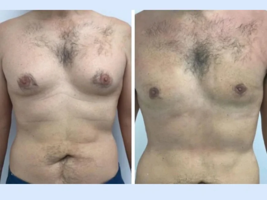 Understanding the Psychological Side of Gynecomastia in Dubai