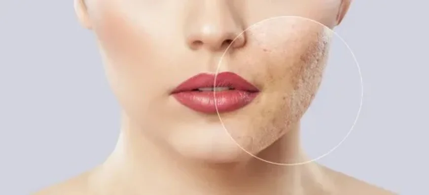 Laser vs Microneedling Acne Scar Treatment in Islamabad