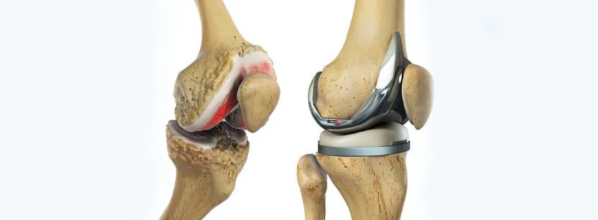 Best Knee Replacement Myths Busted: What Doctors Want You to Know