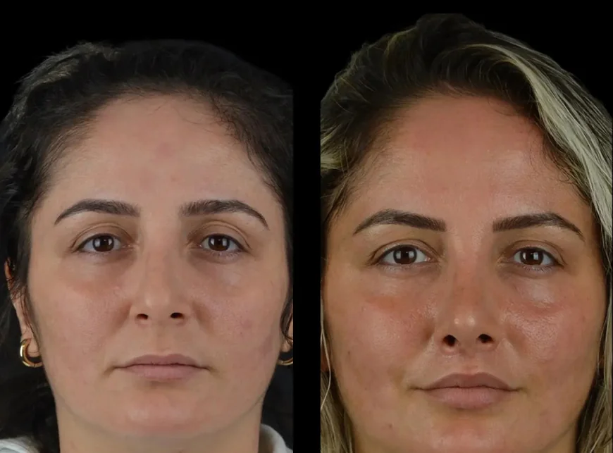 Innovative Techniques for Cheek Fillers Used by the Best Plastic Surgeons in Dubai