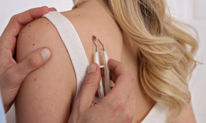 Is Skin Tag Removal in Islamabad Expensive?