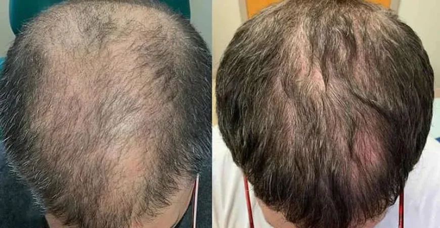 Revive Your Hair Naturally with Exosome Hair Therapy in Islamabad