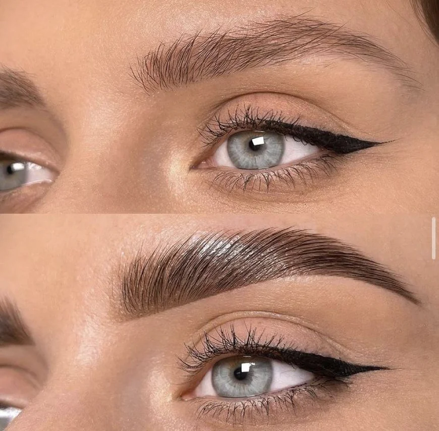 What to Expect Before and After Brow Lift Surgery in Riyadh