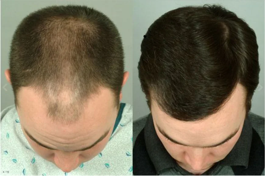 Can FUE Hair Transplant in Islamabad Stop Further Hair Loss?