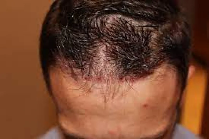 Hair Transplant Cost: Small vs Large Area